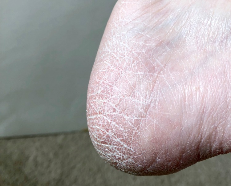 dry skin on heel of foot